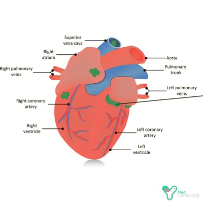 здоровое сердце против аневризмы сердца анатомия левый желудочковый  аневризмический настенный буль трансмуральный ущерб развивает Иллюстрация  штока - иллюстрации насчитывающей миокардиально, боль: 244970673
