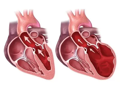 Вы знаете что такое аневризма сердца? Рассказываем о грозном осложнении  инфаркта и не только | О здоровье: с медицинского на русский | Дзен