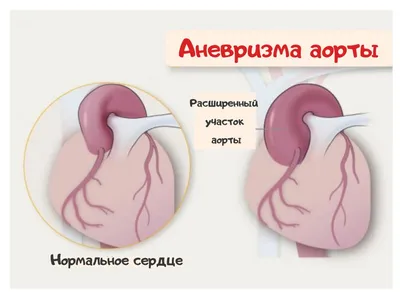 Лечение аневризмы аорты в Германии у лучших специалистов : YY MedConsulting  GmbH