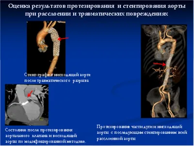 Что нужно знать о синдроме Марфана и жизни с ним