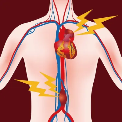 Аневризма аорты, периферических артерий