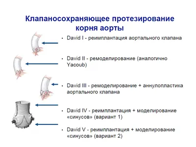 A clinical case of a successful step-by-step treatment of a patient with a  dissecting aneurysm of the ascending aorta involving the trunk of the left  coronary artery - Bocharov - Journal of