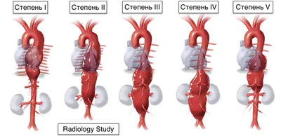 Расслаивающая аневризма аорты