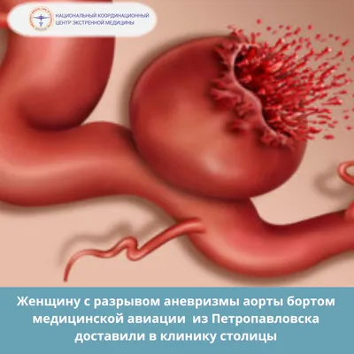 Аневризма аорты - признаки, причины, симптомы, лечение и профилактика -  iDoctor.kz