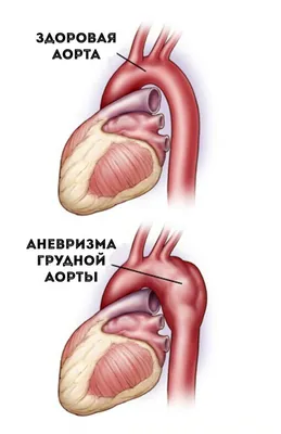 Аневризма аорты: симптомы, причины, диагностика, лечение| АО «Медицина»  (клиника академика Ройтберга)