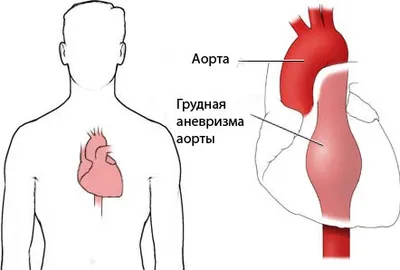 Аневризма Восходящей Аорты — стоковые фотографии и другие картинки Аневризма  - Аневризма, Аорта, Восходящий отдел аорты - iStock