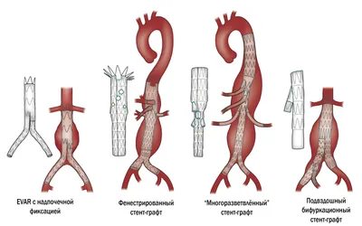 Признаки аневризмы брюшной аорты и причины