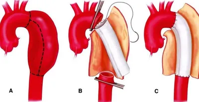 Эндоваскулярное протезирование брюшного отдела аорты