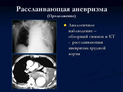 Эндопротезирование – лапаротомии или лапароскопии лечение аневризма аорты