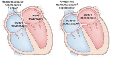 Ложная аневризма дуги аорты под маской опухолевого процесса и медиастинита  | Інтернет-видання \"Новини медицини та фармації\"