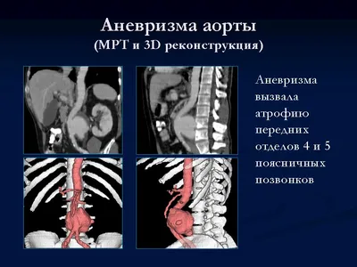 Патологии аорты - симптомы по дням у детей и взрослых, диагностика и  способы лечения