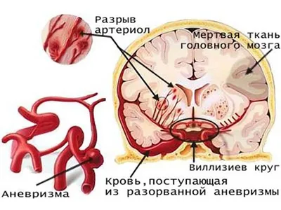 Анатомия Сердца И Типы Иллюстрации Вектора Сердечнососудистых Заболеваний —  стоковая векторная графика и другие изображения на тему Аневризма - iStock