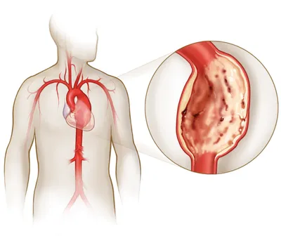 Аневризма: аорты, в т.ч. брюшной, сосудов головного мозга, сердца