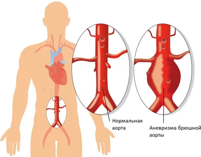 Диагностика и лечение аневризмы на сердце | Лайфхаки ру | Дзен