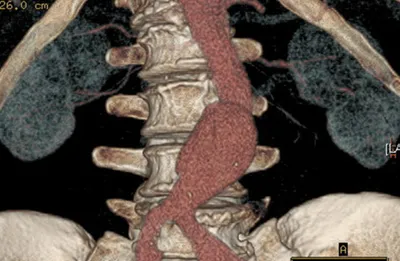 Аневризма аорты брюшной полости: симптомы, диагностика, лечение, операция,  клинические рекомендации