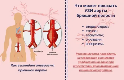 Клинический случай лечения больной с расслаивающей аневризмой аорты