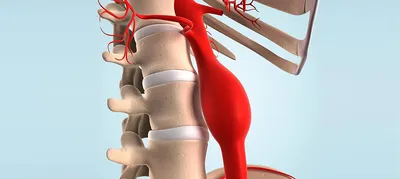 Аневризма головного мозга - диагностика и лечение в Херсоне | Neuro.ks.ua.