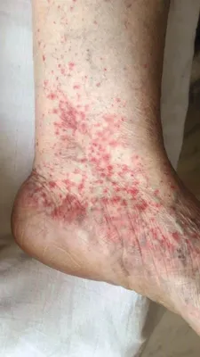 Skin manifestations of a new coronovirus infection COVID-19 caused by  SARS-CoV-2 - Khryanin - Vestnik dermatologii i venerologii