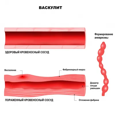 Васкулит — Википедия