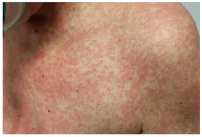 Skin manifestations of a new coronovirus infection COVID-19 caused by  SARS-CoV-2 - Khryanin - Vestnik dermatologii i venerologii