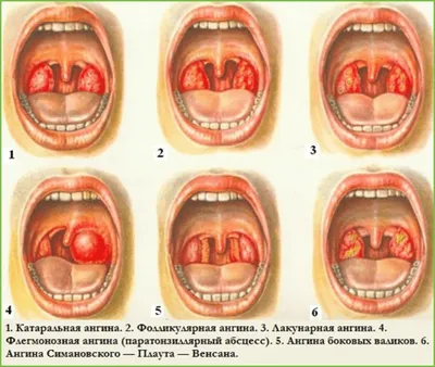 Лечение ангины у детей