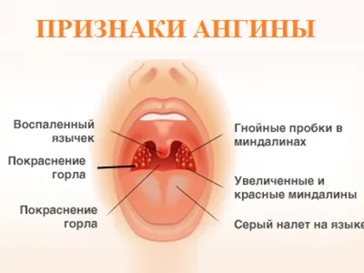 AnnaMama - Про ангину Воспаление небных миндалин и слизистой глотки:  тонзиллит (ангина), фарингит-основная причина боли в горле. Возбудители  ангины-бактерии, вирусы, грибы и др. 1️. Наиболее частые  возбудители-вирусы: антибиотики не нужны проходит ...