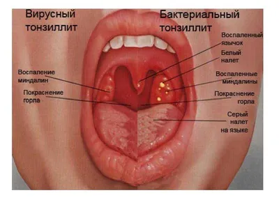 Ангина: причины, и симптомы, лечение, диагностика и профилактика ангины