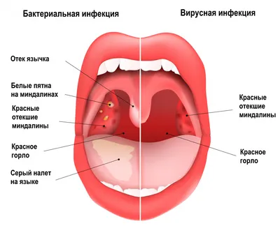 Болит горло так, что не могу глотать: возможно, это ангина! Врач  рассказала, чем она так опасна | О здоровье: с медицинского на русский |  Дзен