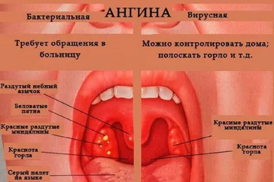 Ангина у детей и взрослых. Причины, симптомы, лечение – Семейная клиника  «Доктор АННА»