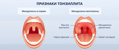 Паратонзиллярный абсцесс: методы лечения и диагностики заболевания ᐉ Сеть  аптек «Бажаємо здоров'я»