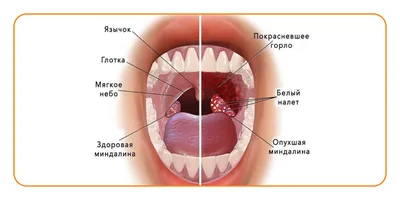 Флегмонозная ангина - причины, симптомы, диагностика, лечение и профилактика