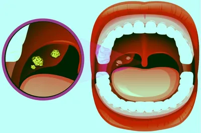 Ангина - признаки, симптомы, диагностика и лечение | острый тонзиллит у  взрослых и детей