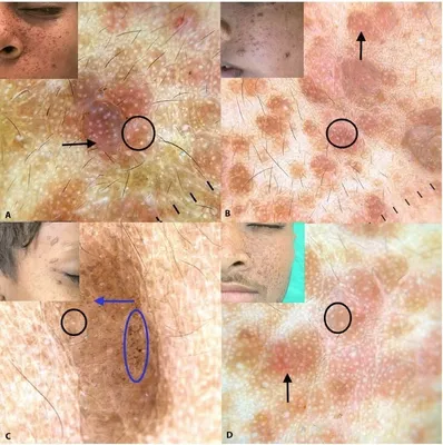 Ангиофибромы лица у пациентов с туберозным склерозом | DERMATOLOGY-ONLINE |  Дзен