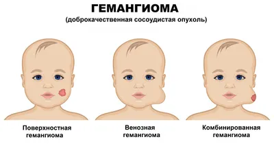 Лазерное удаление ангиомы – фотографии до и после