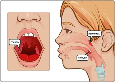 Доброкачественные опухоли глотки - признаки, причины, симптомы, лечение и  профилактика - iDoctor.kz