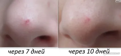 Удаление новообразований полости рта, лица и шеи | ООО «Вега Дент»