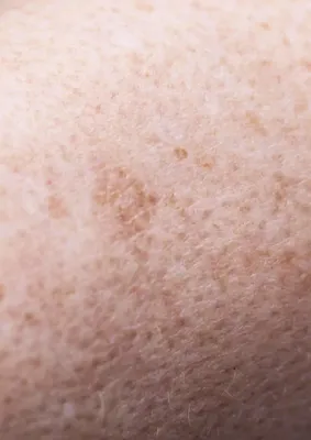 Диагностика рака кожи в Германии — Наиболее информативные методы
