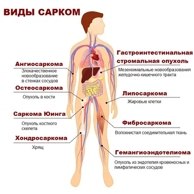 Саркома - причины появления, симптомы заболевания, диагностика и способы  лечения