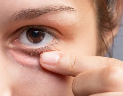Ангулярный конъюнктивит: лечение воспаления глаз по типу моракса аксенфельда