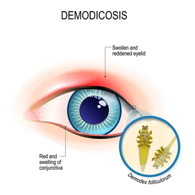 Воспалительные заболевания вспомогательных органов глаза и орбиты -  презентация, доклад, проект