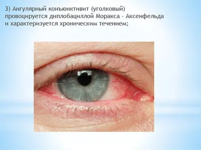 Боль в уголках глаз - симптомы, причины лечение