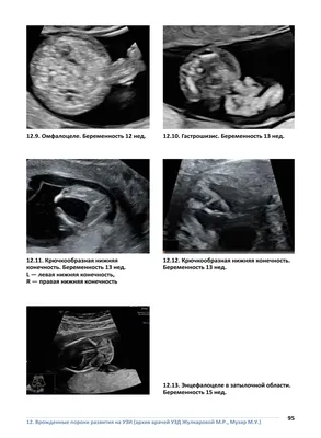 Диагностика врожденных пороков развития плода во втором триместре  беременности – тема научной статьи по клинической медицине читайте  бесплатно текст научно-исследовательской работы в электронной библиотеке  КиберЛенинка