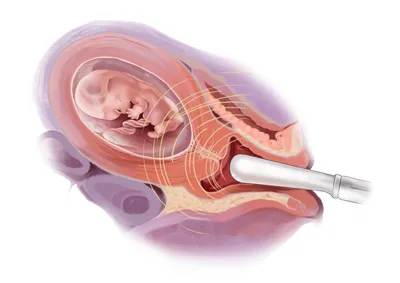 Pregnancy Scan London: Скрининг и УЗИ при беременности - Что такое скрининг развития  ребенка в 3 триместре? Наш скрининг развития плода на этом сроке направлен  на исключение аномалий плода, которые проявляются на
