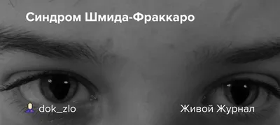 Антимонголоидный разрез глаз, расщепление нёба и другие серьезные проблемы  | Пикабу