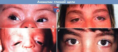 Аномалии глазной щели - варианты
