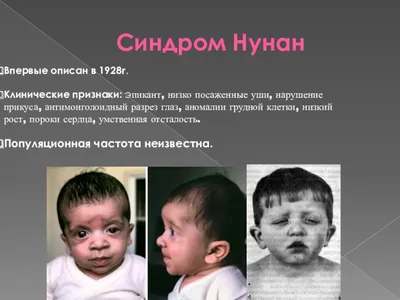 Хромосомные болезни человека - презентация, доклад, проект