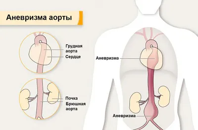 Как и где лечить коарктацию (сужение) аорты в Кыргызстане