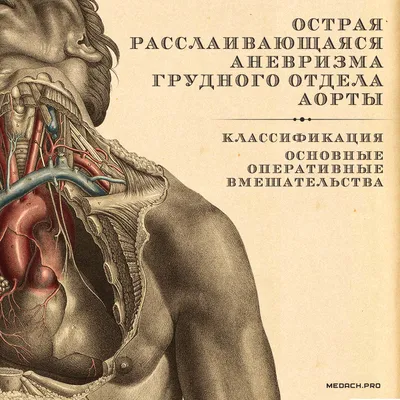 Аневризма аорты: причины, симптомы, диагностика и лечение