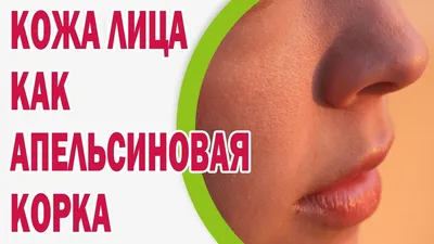 Тейпирование ягодиц помощь в борьбе с целлюлитом