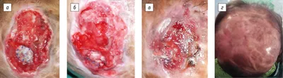 Комплексная регенерация кожи головы при врожденной аплазии с использованием  заменителя дермы Integra - Yap - Ортопедия, травматология и  восстановительная хирургия детского возраста